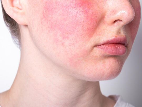 Ból oczu i podrażnienia – okulistyczne aspekty trądziku różowatego