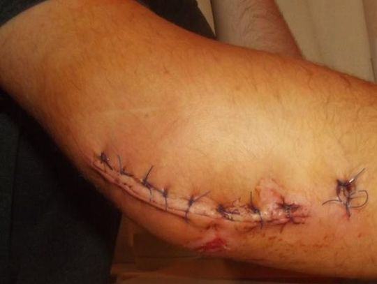 Krawężnik, upadek i druty w łokciu