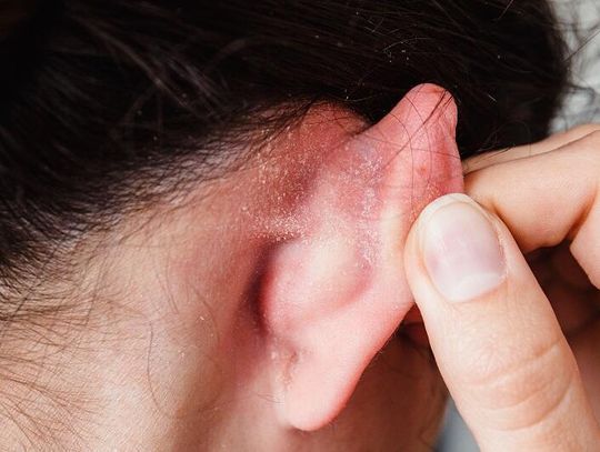 Łuszczyca skóry głowy a wypadanie włosów – jak chronić fryzurę?