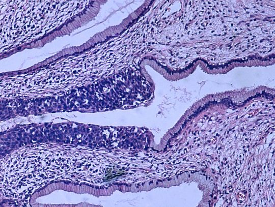 Profilaktyka raka szyjki macicy – dlaczego warto wybrać cytologię płynną?