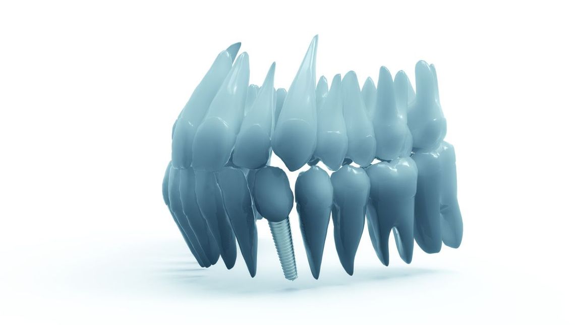 Czym jest implant zęba?