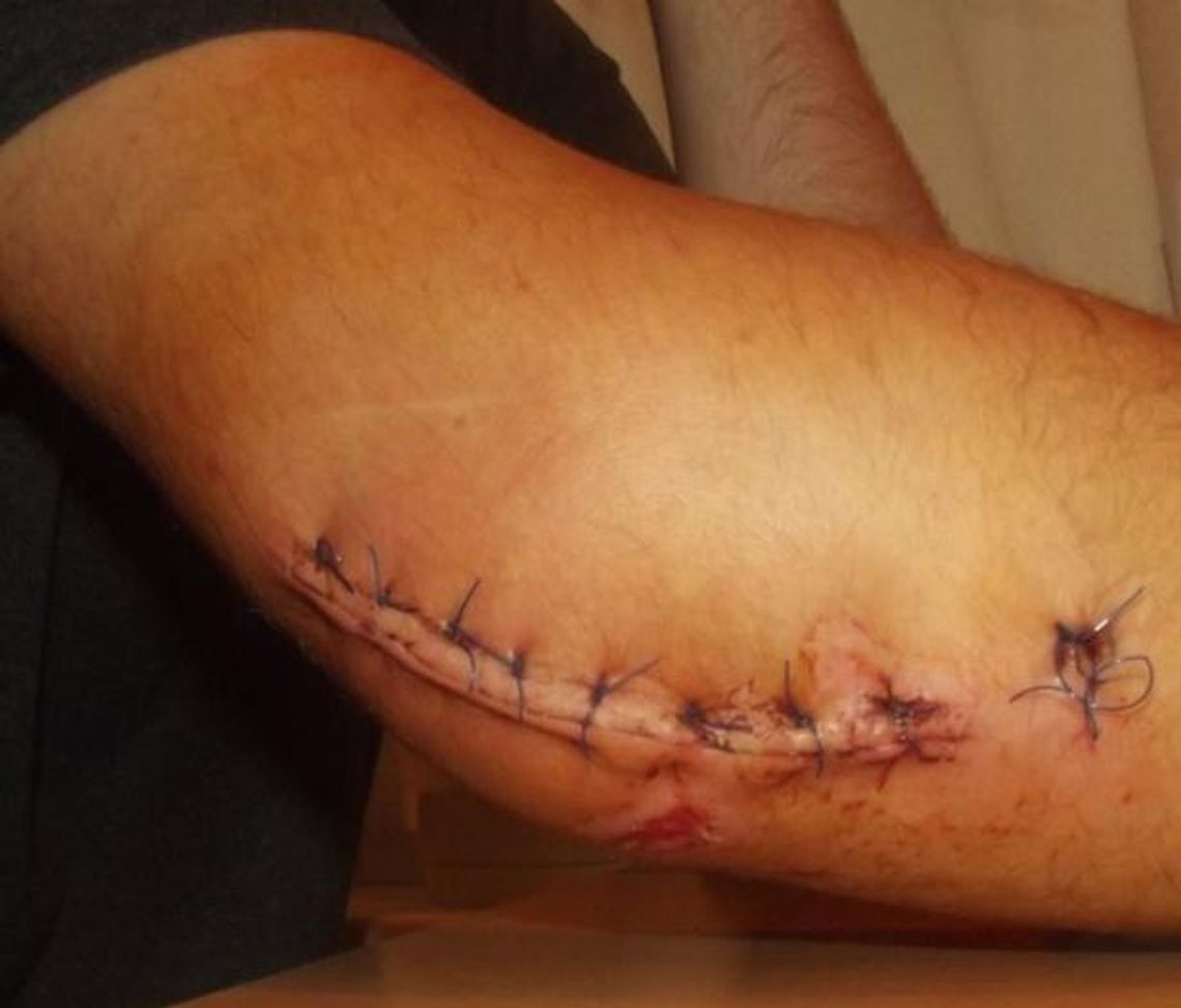 Krawężnik, upadek i druty w łokciu Krawężnik, upadek i druty w łokciu